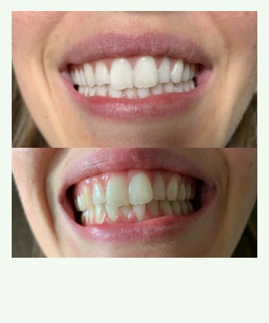 "I noticed a difference in my teeth colour. They are definitely whiter".