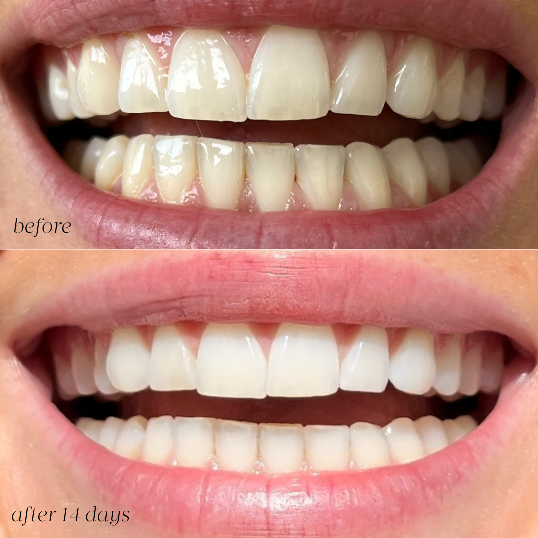 Dissolvable Teeth Whitening Strips